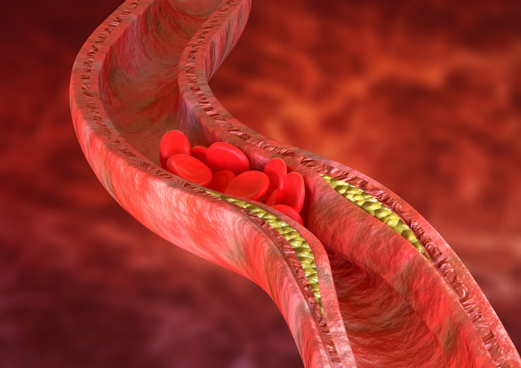 arteries getting clogged by fatty blood vessels high cholesterol